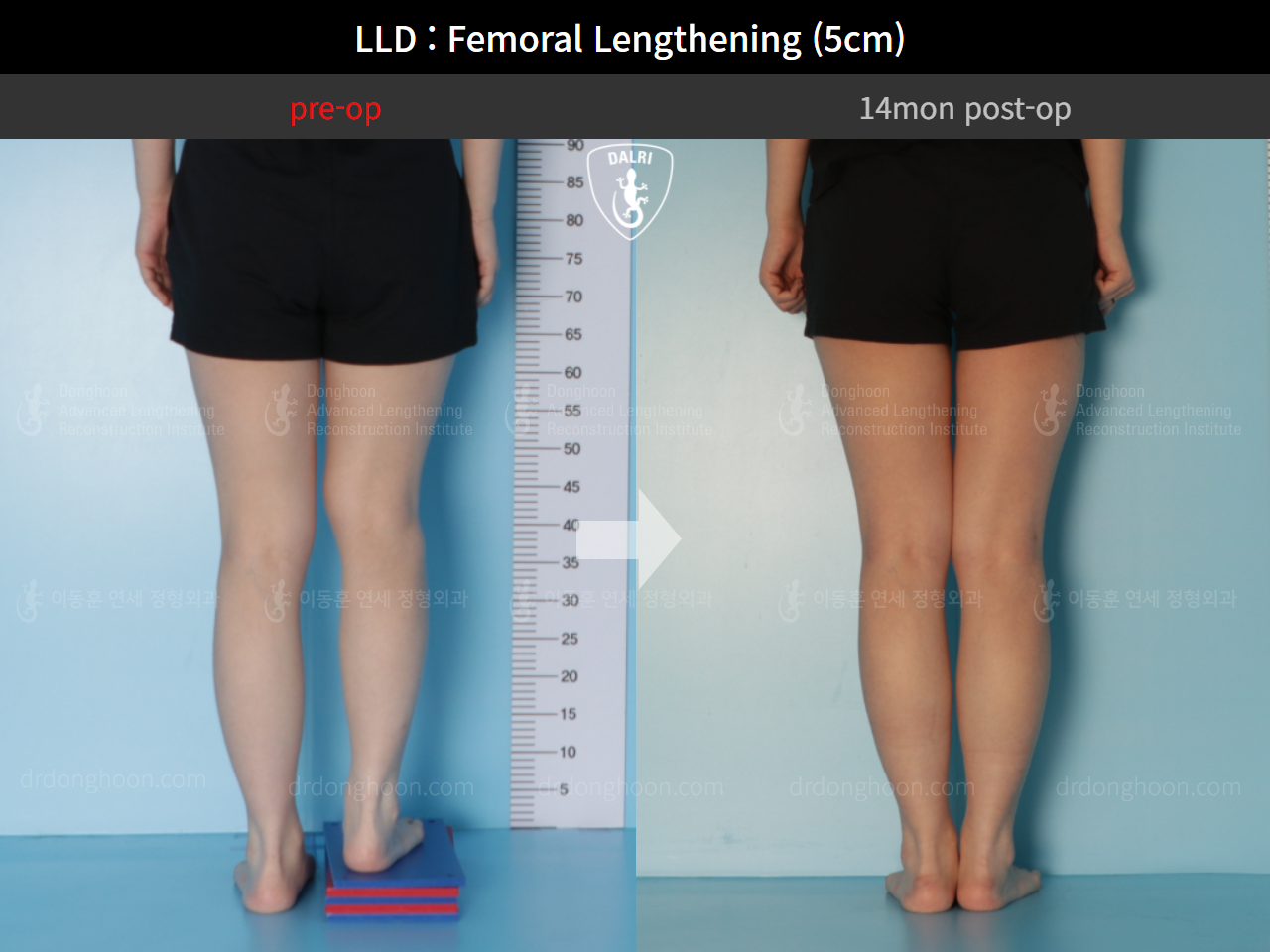 Before and after adult lld, case 9366304, image 7, Dr. Donghoon institute (DALRI)