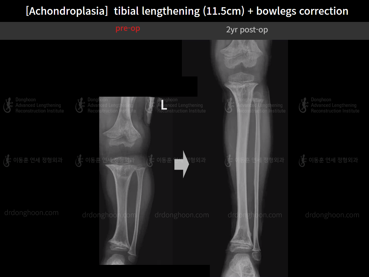 Before and after paediatric congenital condition, case 14957539, image 6, Dr. Donghoon institute (DALRI)