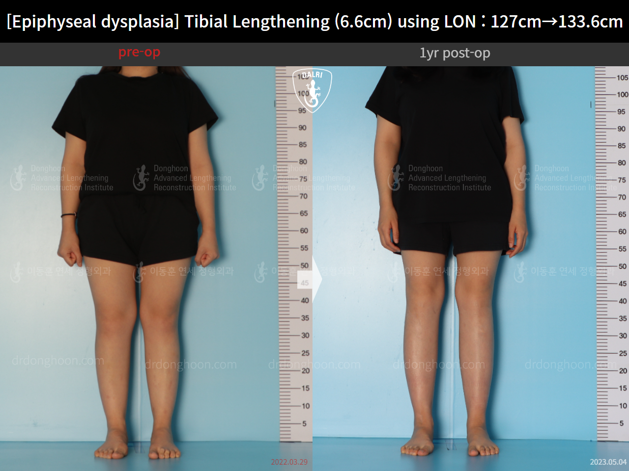 Before and after congenital condition, case 15072062, image 2, Dr. Donghoon institute (DALRI)