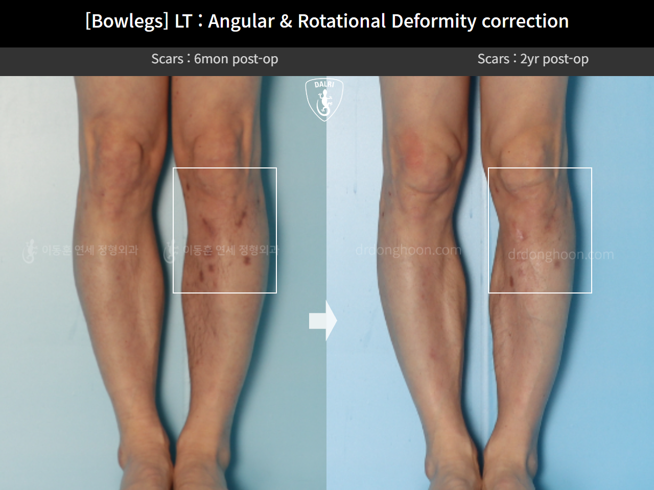 Before and after adult bowlegs, case 15111863, image 9, Dr. Donghoon institute (DALRI)