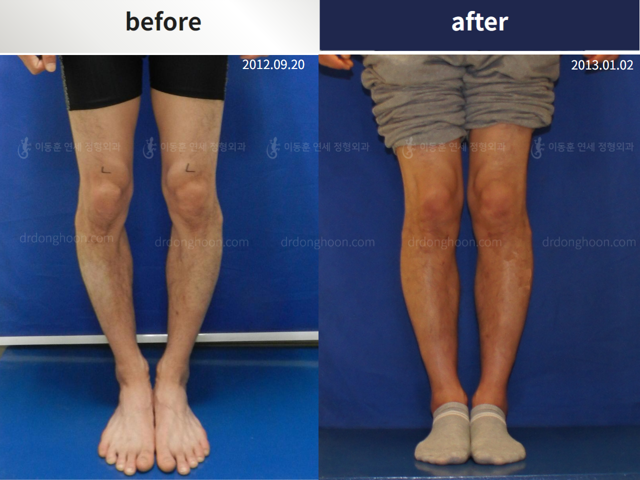 Before and after adult bowlegs, case 4311126, image 1, Dr. Donghoon institute (DALRI)