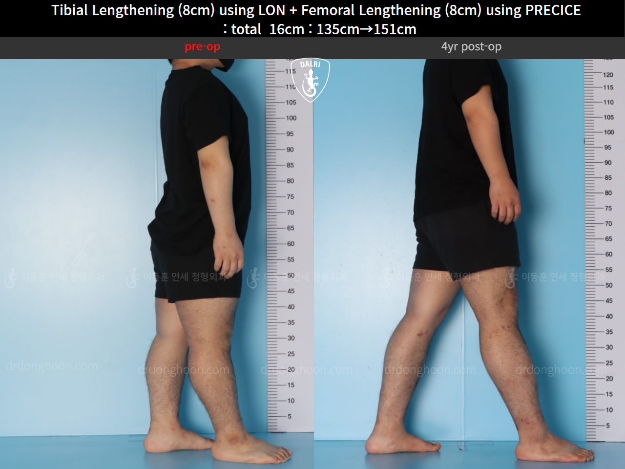 Before and after cll precice, case 128435842, image 5, Dr. Donghoon institute (DALRI)