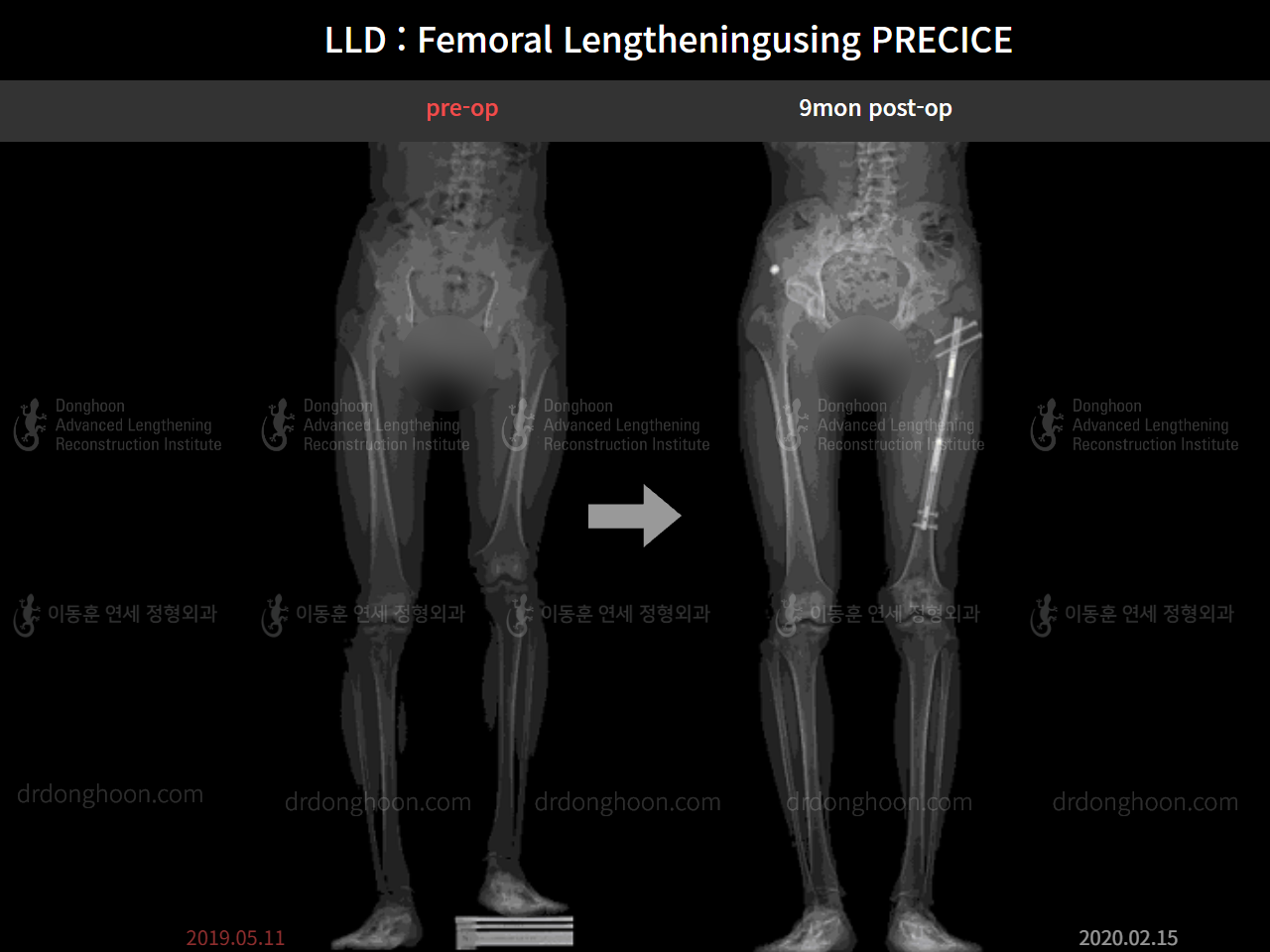 Before and after adult lld, case 8482519, image 4, Dr. Donghoon institute (DALRI)