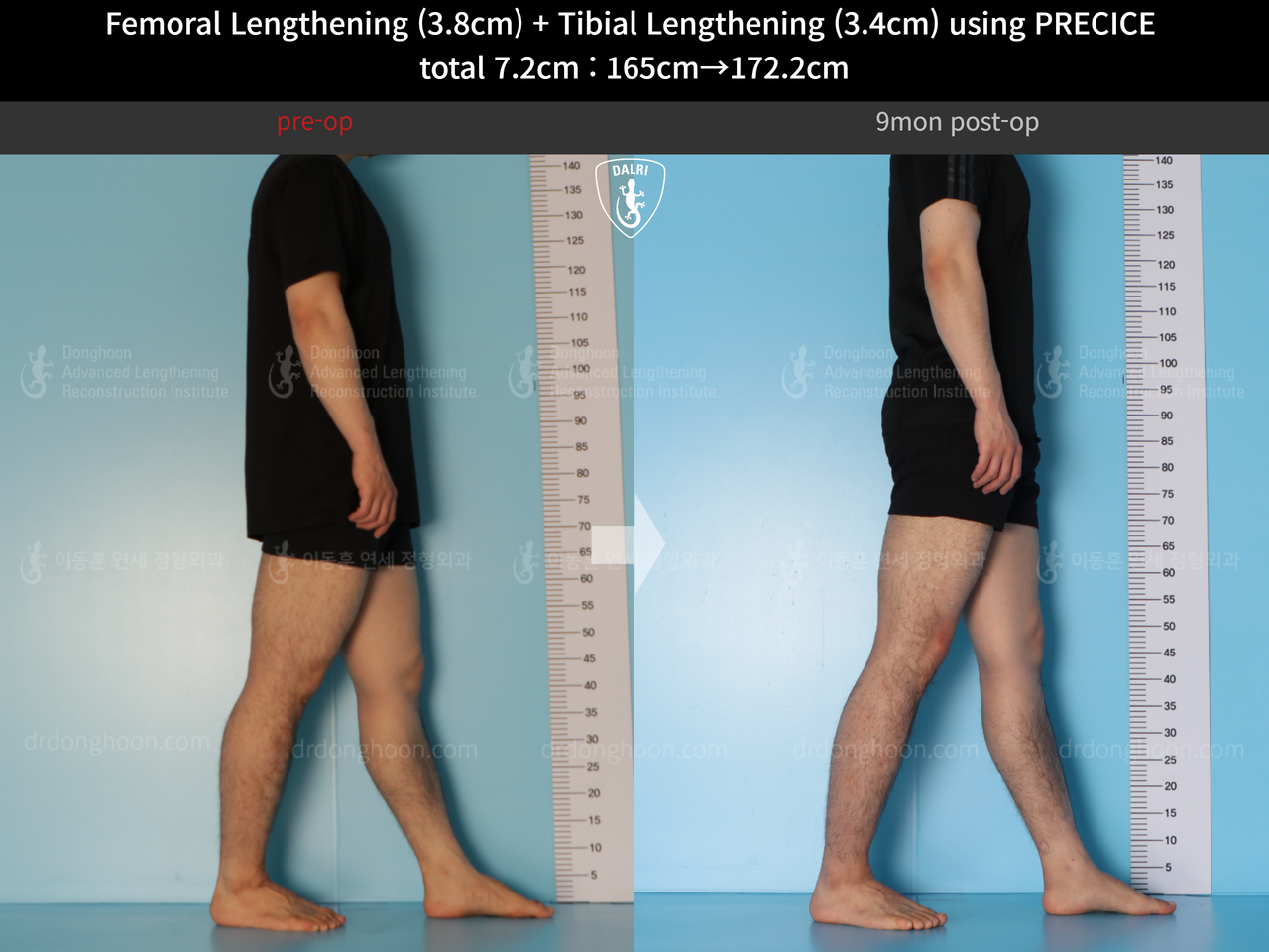 Before and after cll precice, case 14220657, image 4, Dr. Donghoon institute (DALRI)
