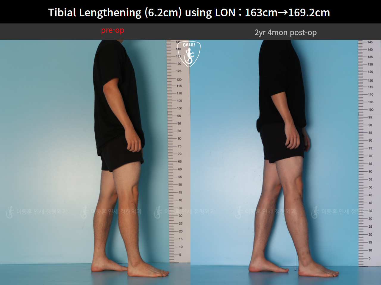 Before and after cll lon, case 128449546, image 5, Dr. Donghoon institute (DALRI)