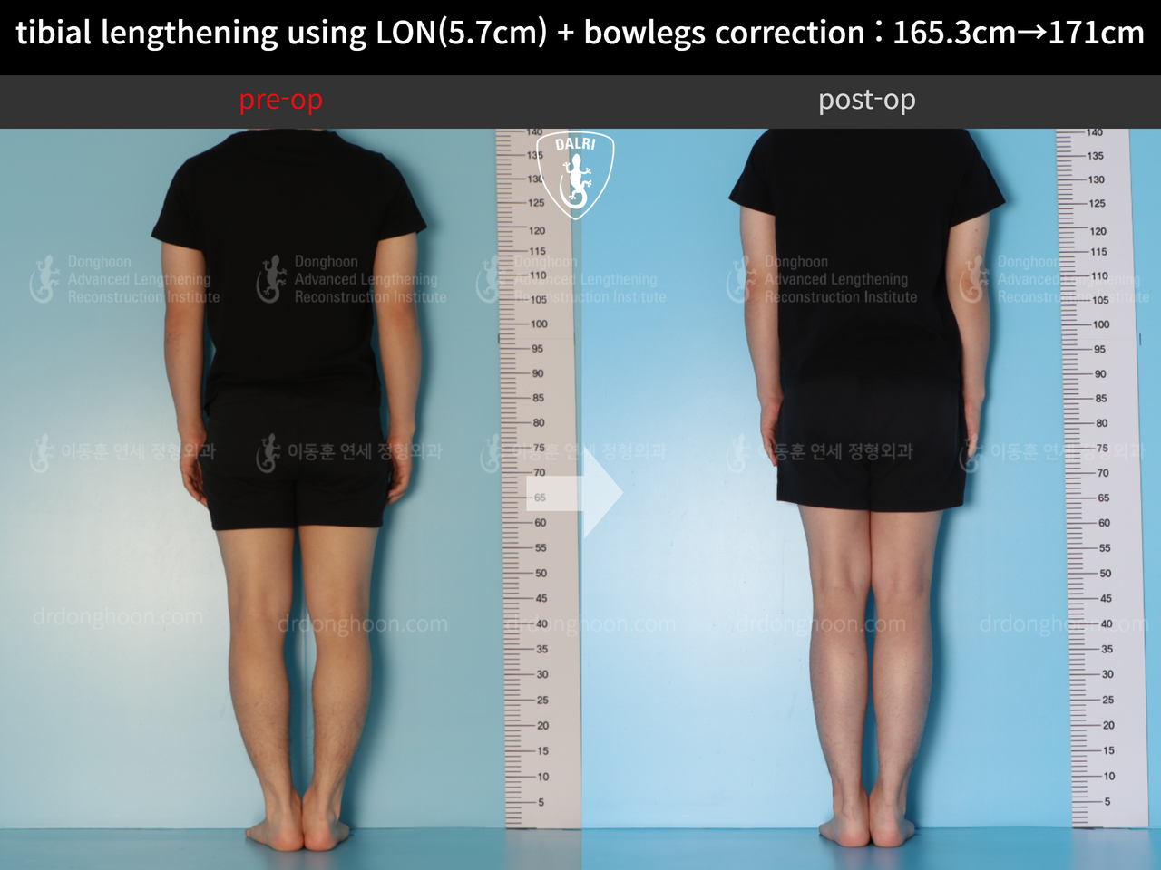 Before and after cll + deformity correction, case 12679153, image 2, Dr. Donghoon institute (DALRI)