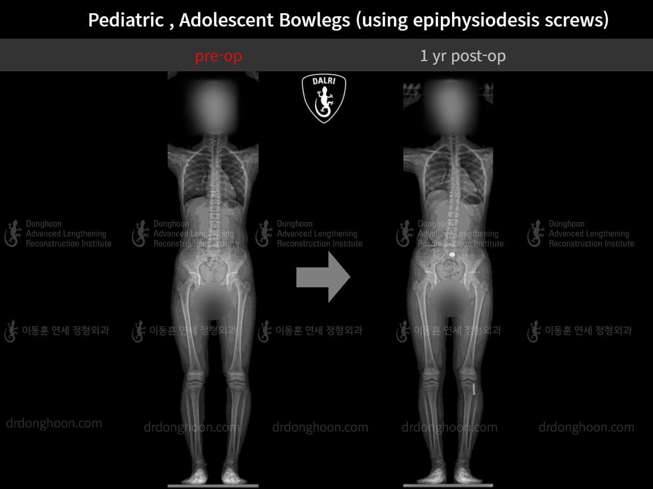 Before and after paediatric & adolescent bowlegs, case 9259159, image 4, Dr. Donghoon institute (DALRI)