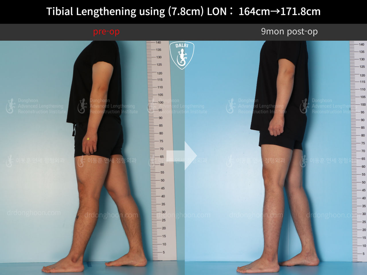 Before and after cll lon, case 12652002, image 4, Dr. Donghoon institute (DALRI)