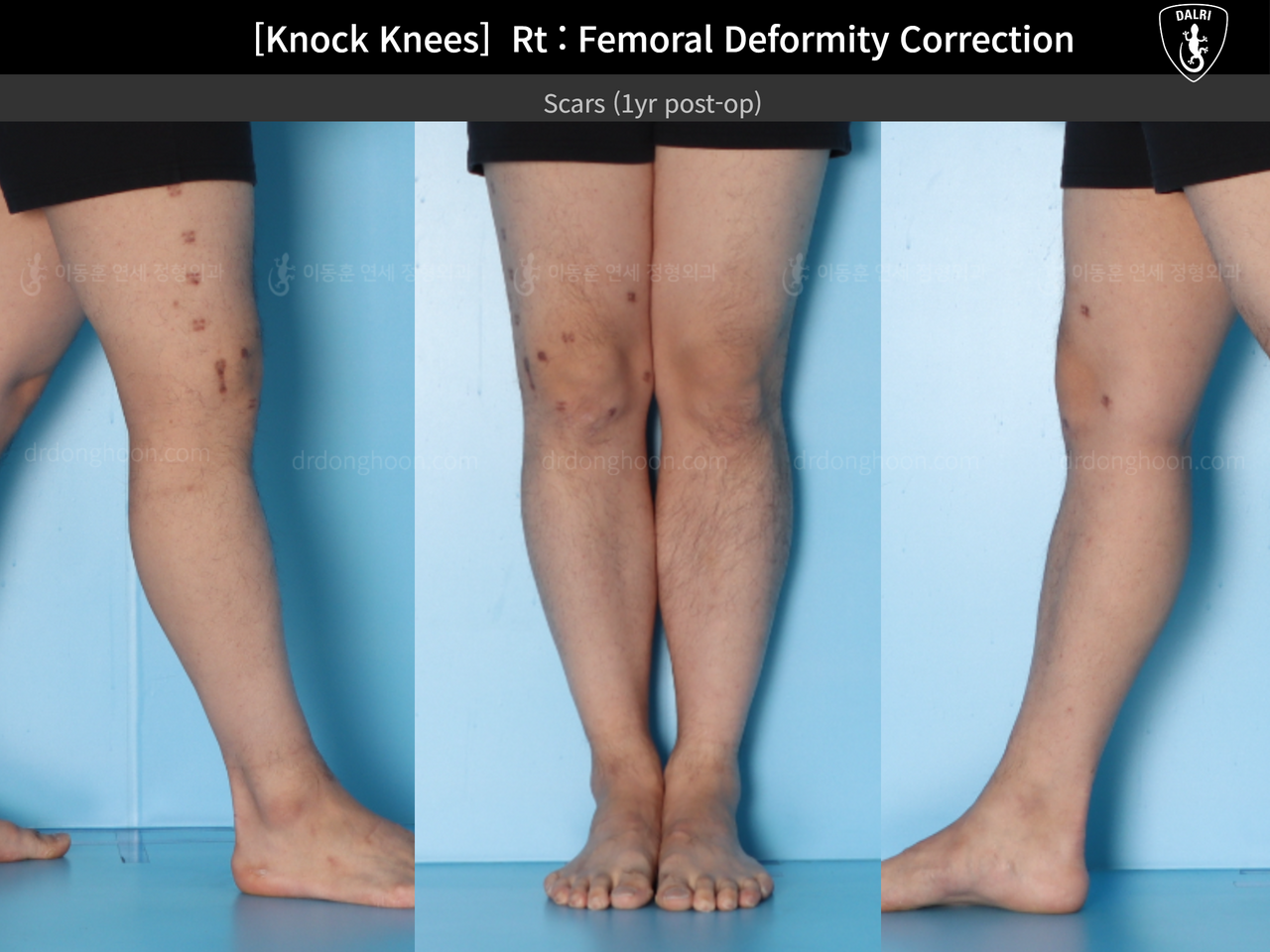 Before and after adult knock knees, case 14009233, image 5, Dr. Donghoon institute (DALRI)