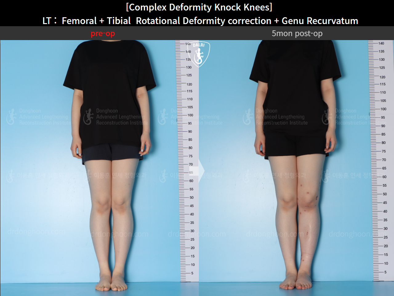 Before and after genu recurvatum, case 16212778, image 2, Dr. Donghoon institute (DALRI)