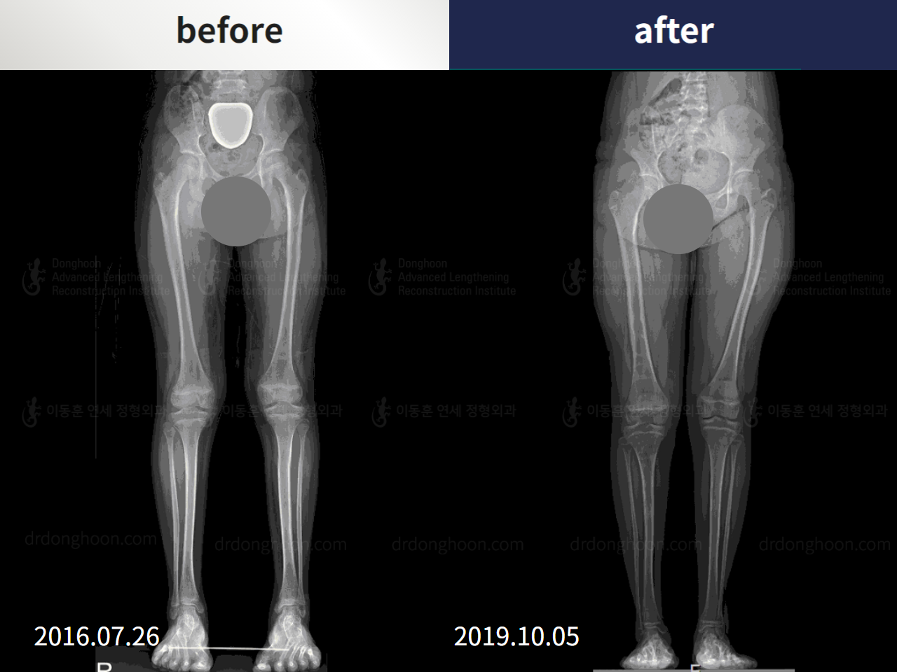 Before and after recurrent patella dislocation, case 4594104, image 2, Dr. Donghoon institute (DALRI)