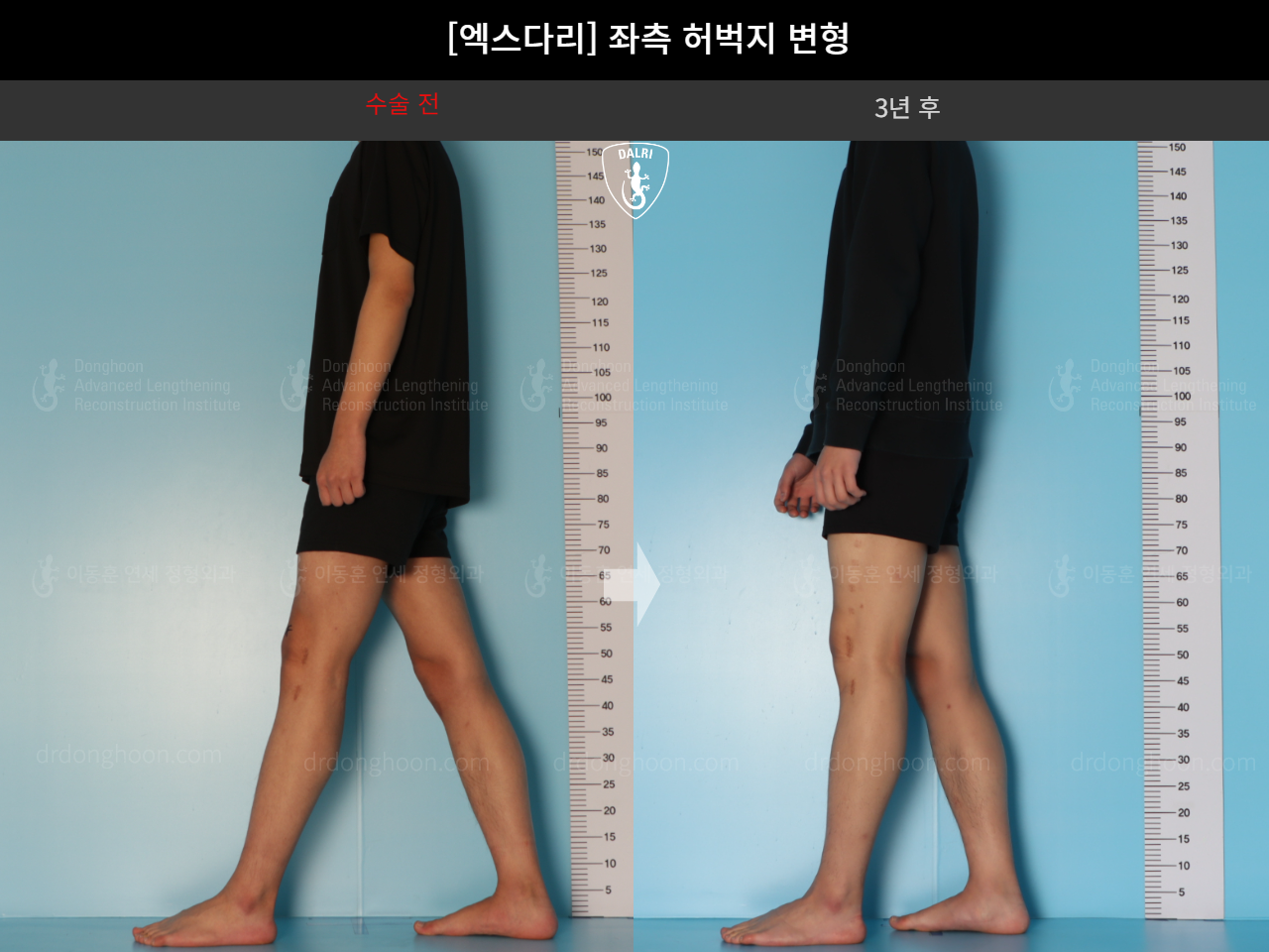 Before and after adult knock knees, case 18261918, image 4, Dr. Donghoon institute (DALRI)