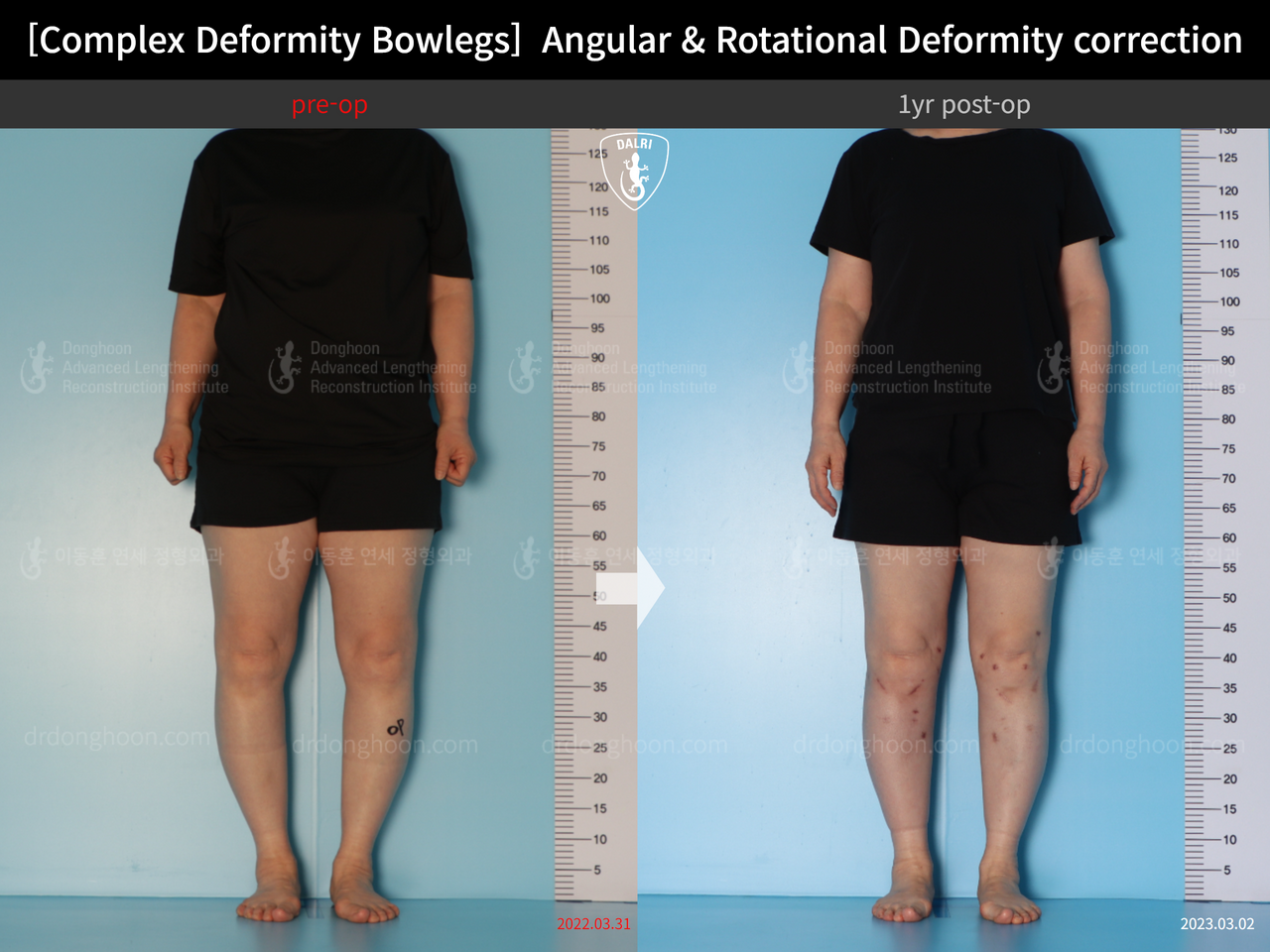 Before and after adult bowlegs, case 14378683, image 2, Dr. Donghoon institute (DALRI)