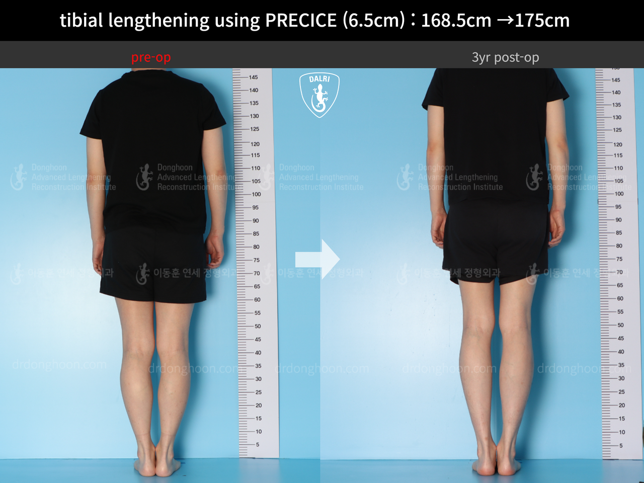 Before and after cll precice, case 13661572, image 4, Dr. Donghoon institute (DALRI)