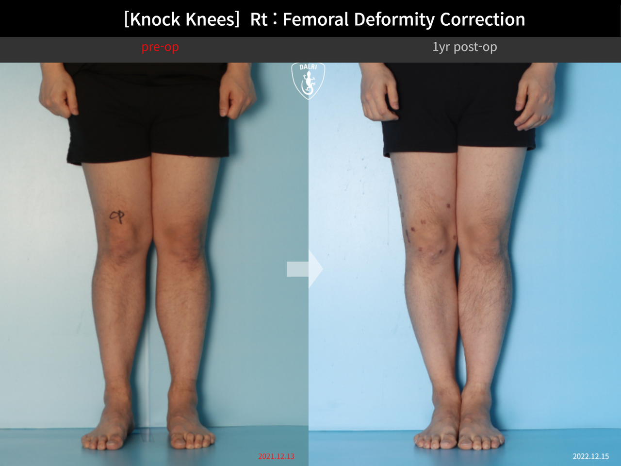 Before and after adult knock knees, case 14009233, image 3, Dr. Donghoon institute (DALRI)