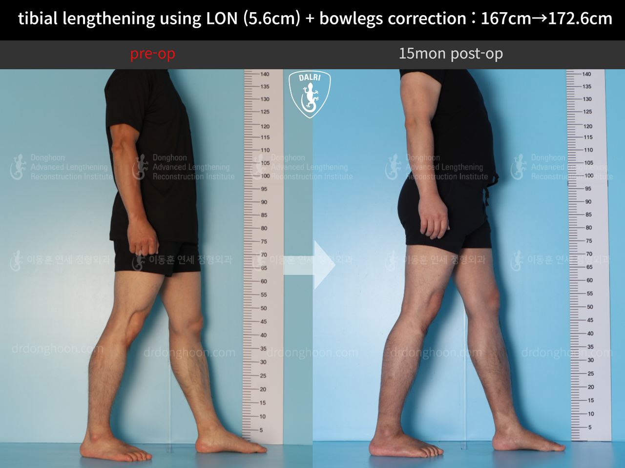 Before and after cll + deformity correction, case 12804946, image 4, Dr. Donghoon institute (DALRI)