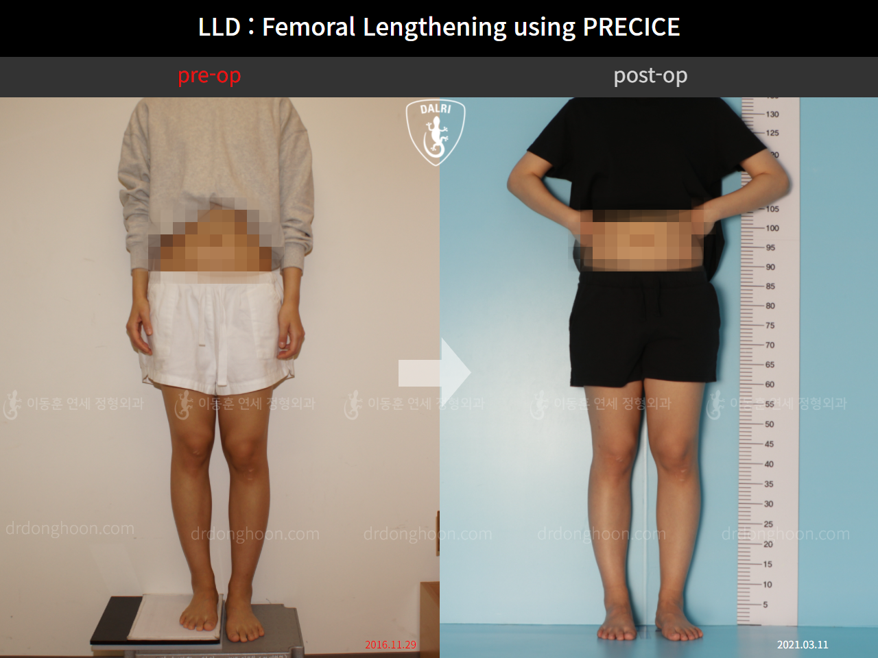 Before and after adult lld, case 10713336, image 1, Dr. Donghoon institute (DALRI)