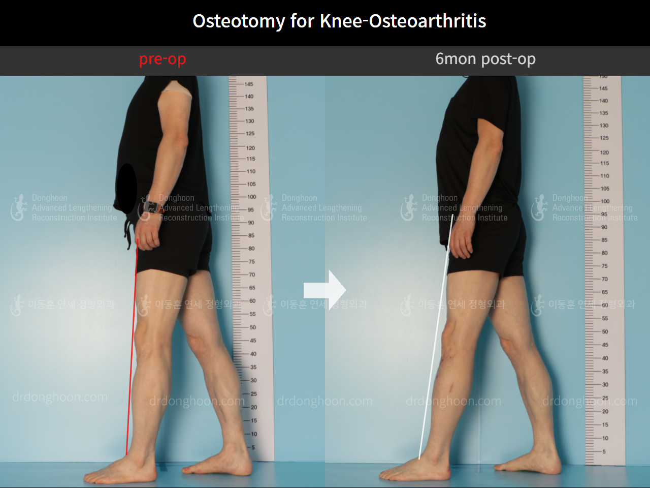 Before and after osteotomy for knee osteoarthritis, case 8796980, image 3, Dr. Donghoon institute (DALRI)