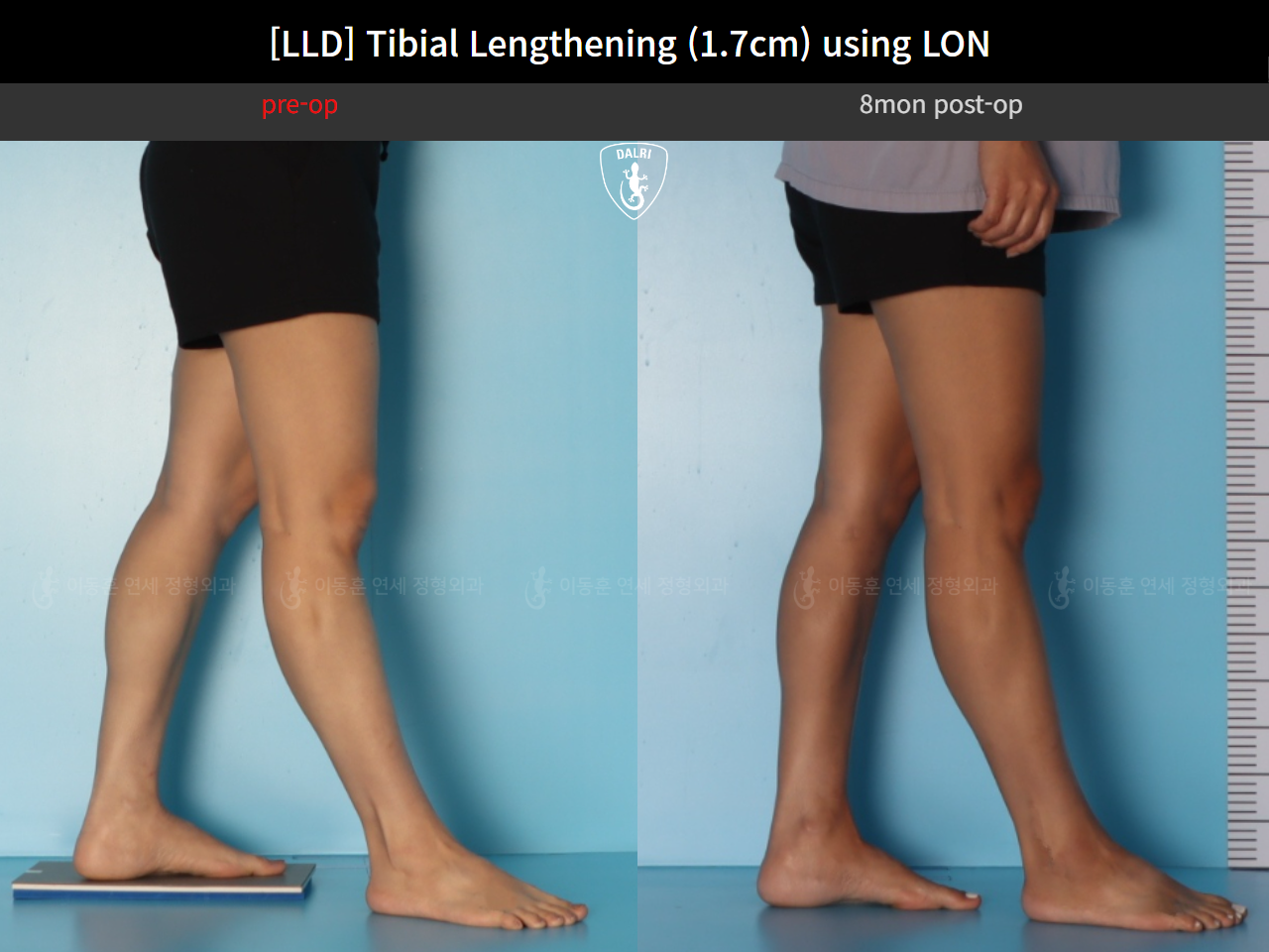 Before and after adult lld, case 126715948, image 7, Dr. Donghoon institute (DALRI)