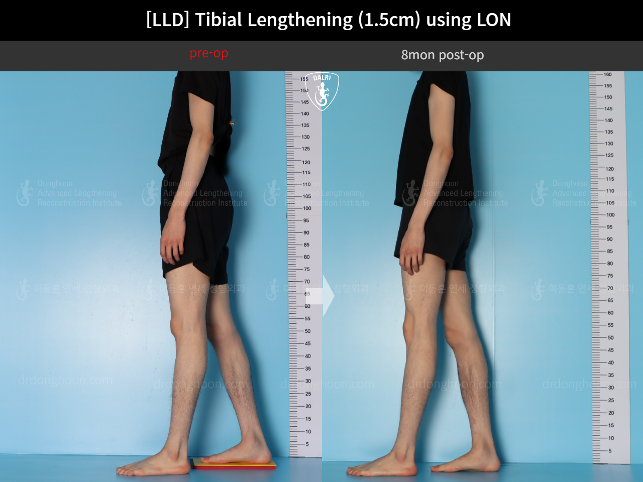 Before and after adult lld, case 18244334, image 4, Dr. Donghoon institute (DALRI)