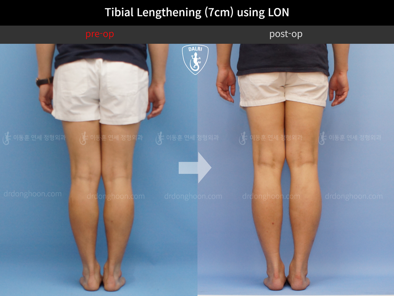Before and after cll lon, case 11990480, image 4, Dr. Donghoon institute (DALRI)