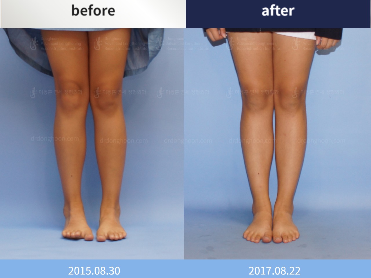 Before and after paediatric & adolescent knock knees, case 4310921, image 1, Dr. Donghoon institute (DALRI)