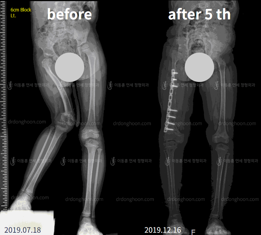 Before and after paediatric congenital condition, case 4304803, image 4, Dr. Donghoon institute (DALRI)