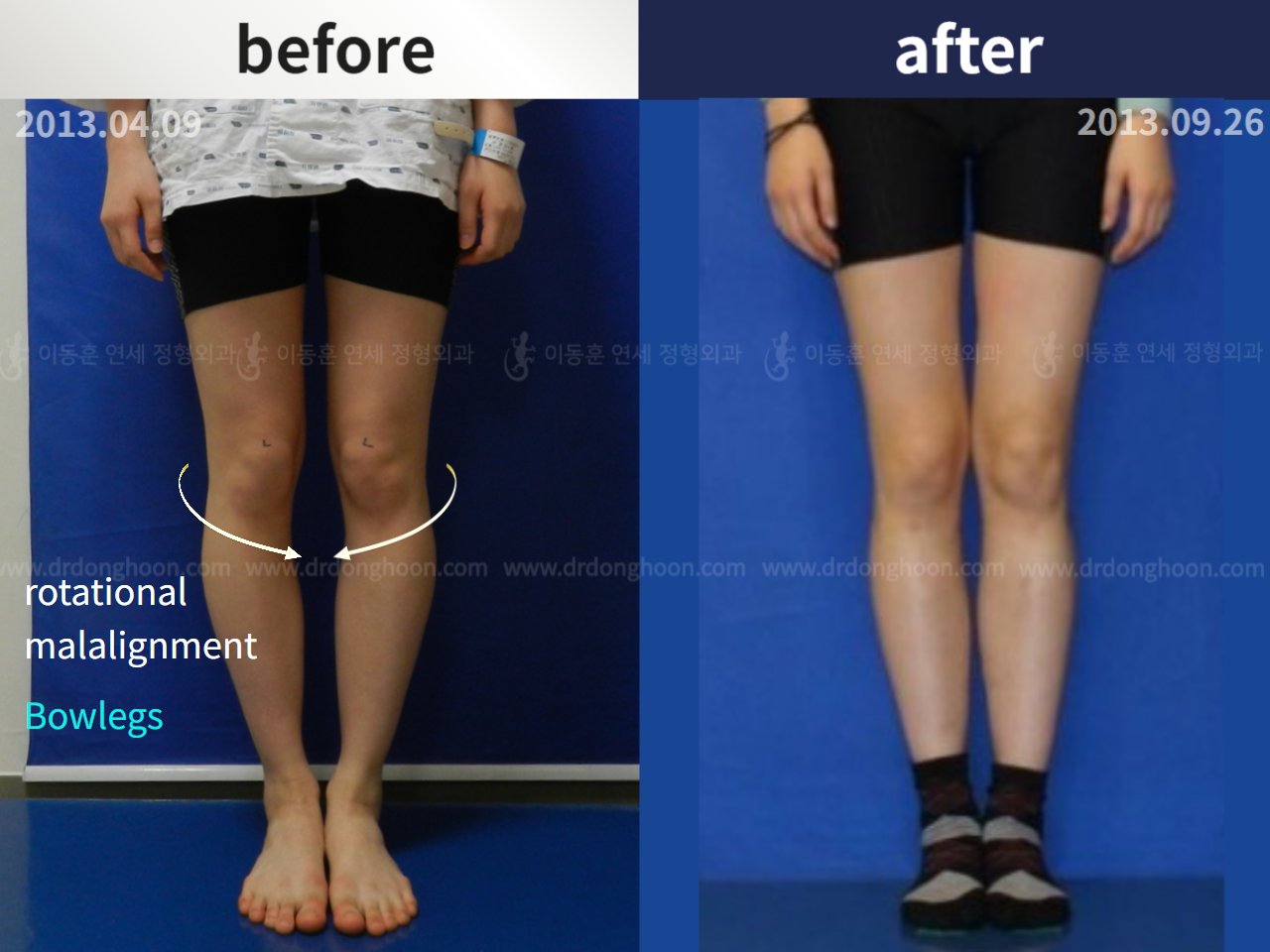 Before and after complex deformity, case 4297310, image 1, Dr. Donghoon institute (DALRI)