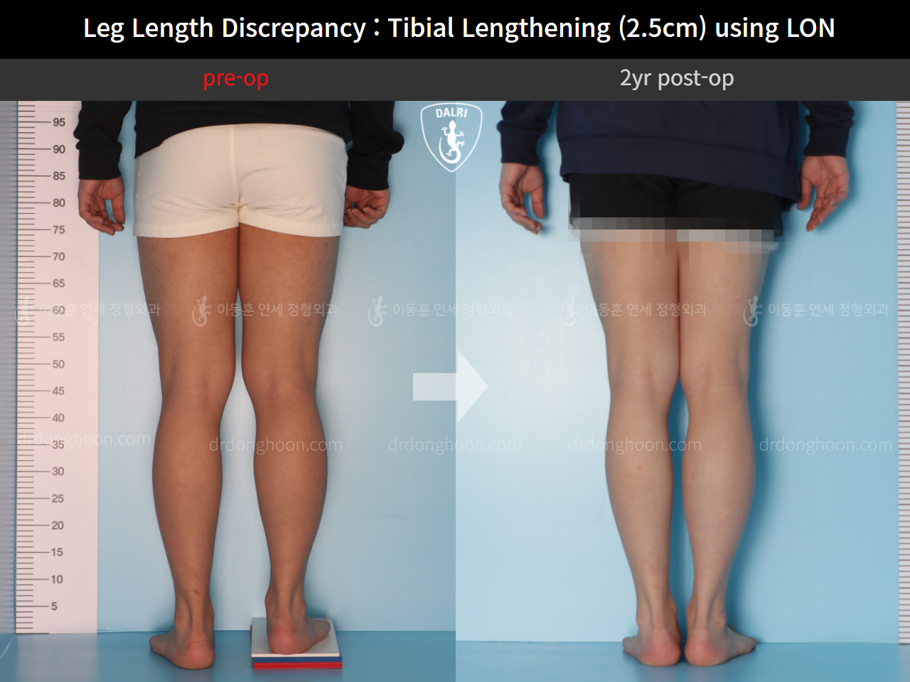 Before and after adult lld, case 9763026, image 4, Dr. Donghoon institute (DALRI)