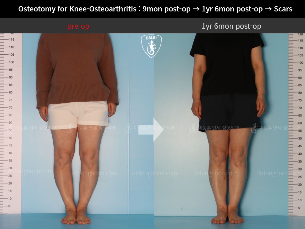 Before and after osteotomy for knee osteoarthritis, case 11203744, image 3, Dr. Donghoon institute (DALRI)