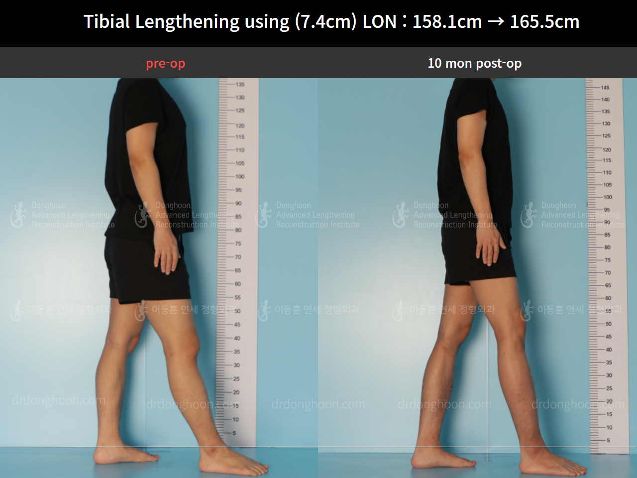 Before and after cll lon, case 8559634, image 3, Dr. Donghoon institute (DALRI)