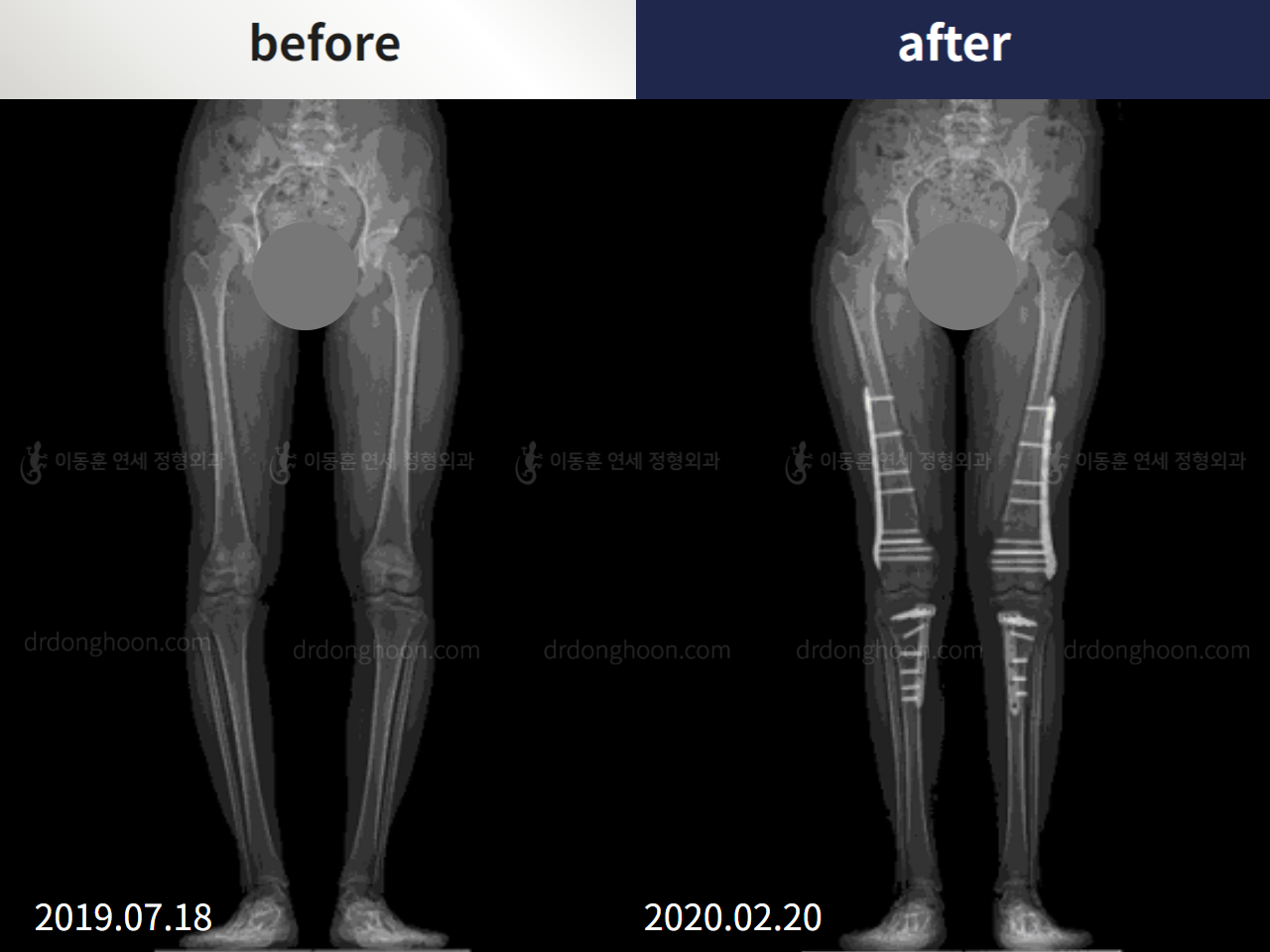 Before and after complex deformity, case 5905795, image 1, Dr. Donghoon institute (DALRI)