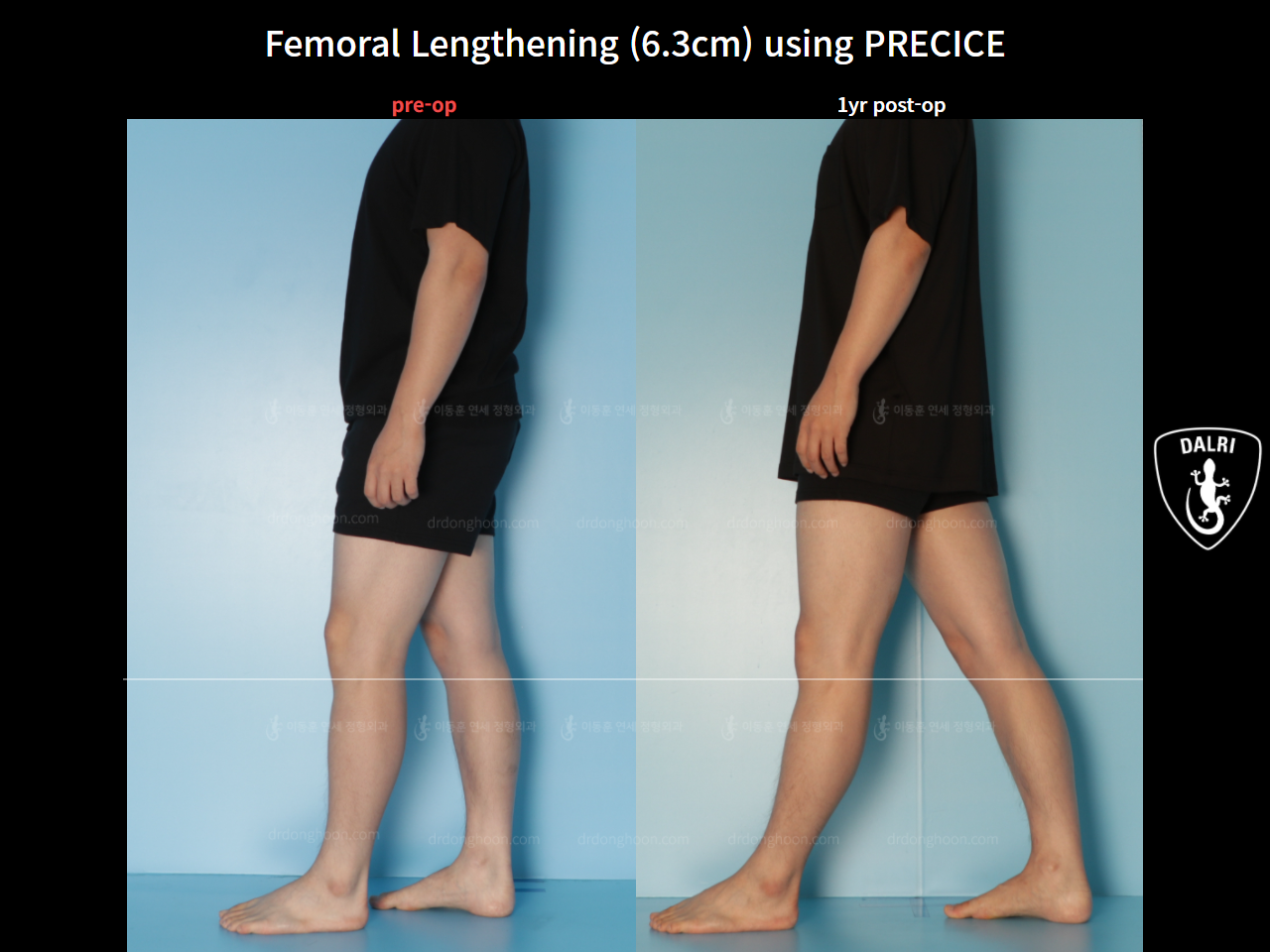 Before and after cll precice, case 7727388, image 3, Dr. Donghoon institute (DALRI)