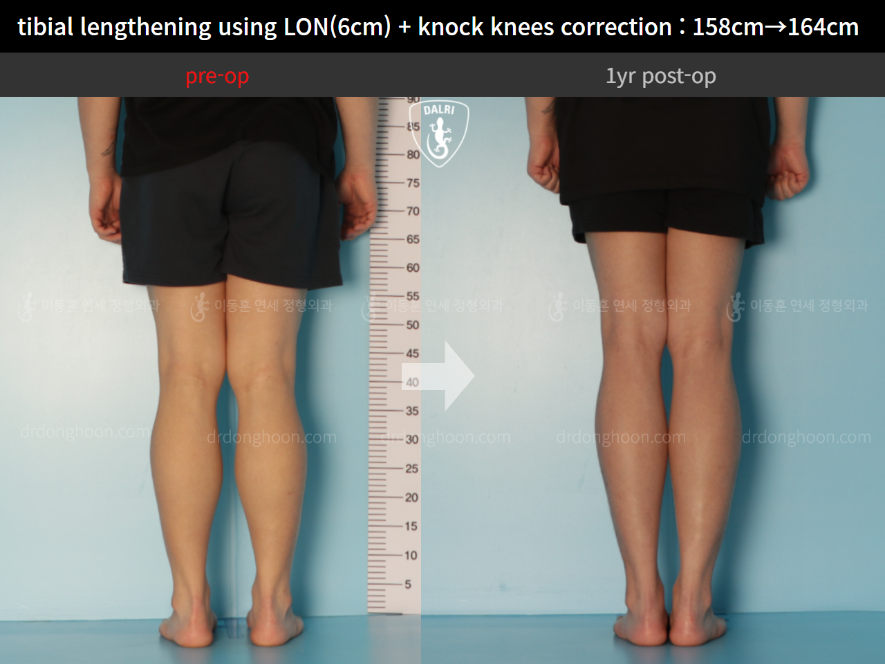Before and after cll + deformity correction, case 9324521, image 6, Dr. Donghoon institute (DALRI)