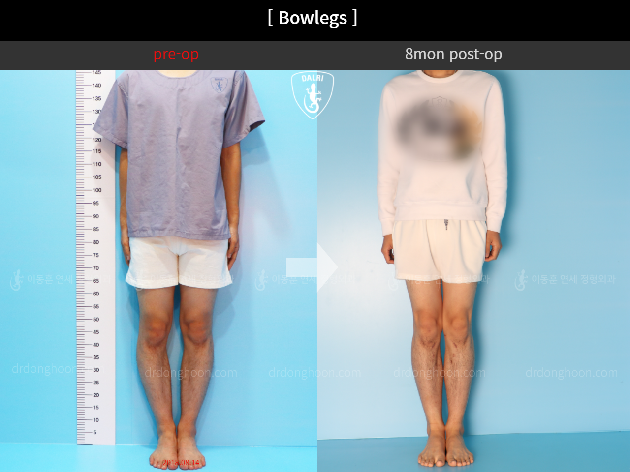 Before and after adult bowlegs, case 4311053, image 4, Dr. Donghoon institute (DALRI)