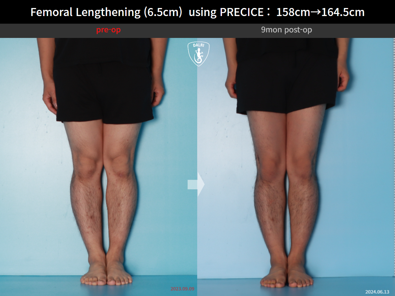 Before and after cll precice, case 28297898, image 7, Dr. Donghoon institute (DALRI)