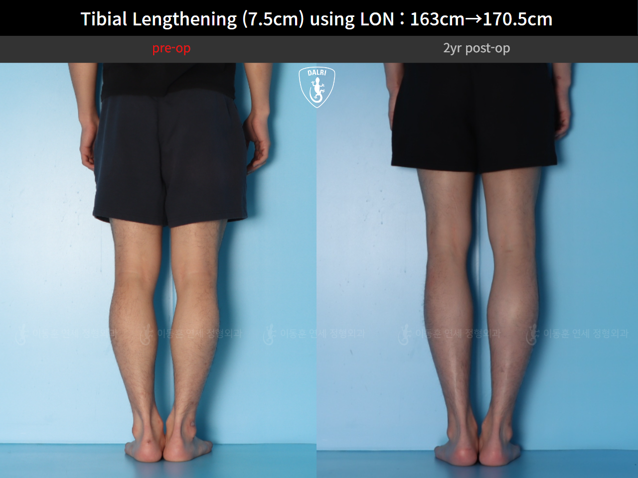 Before and after cll lon, case 125785462, image 10, Dr. Donghoon institute (DALRI)