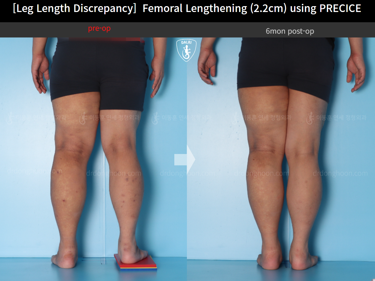 Before and after adult lld, case 15416698, image 6, Dr. Donghoon institute (DALRI)