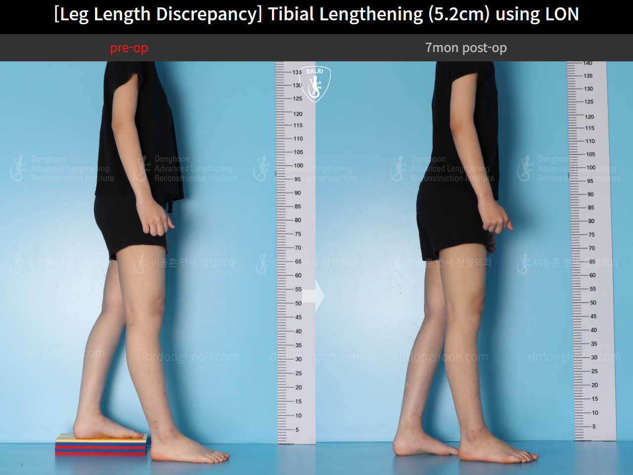 Before and after adult lld, case 16539955, image 3, Dr. Donghoon institute (DALRI)