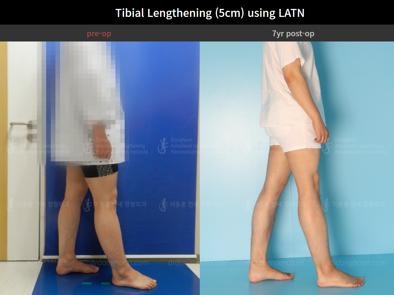 Before and after cll lon, case 8471587, image 3, Dr. Donghoon institute (DALRI)
