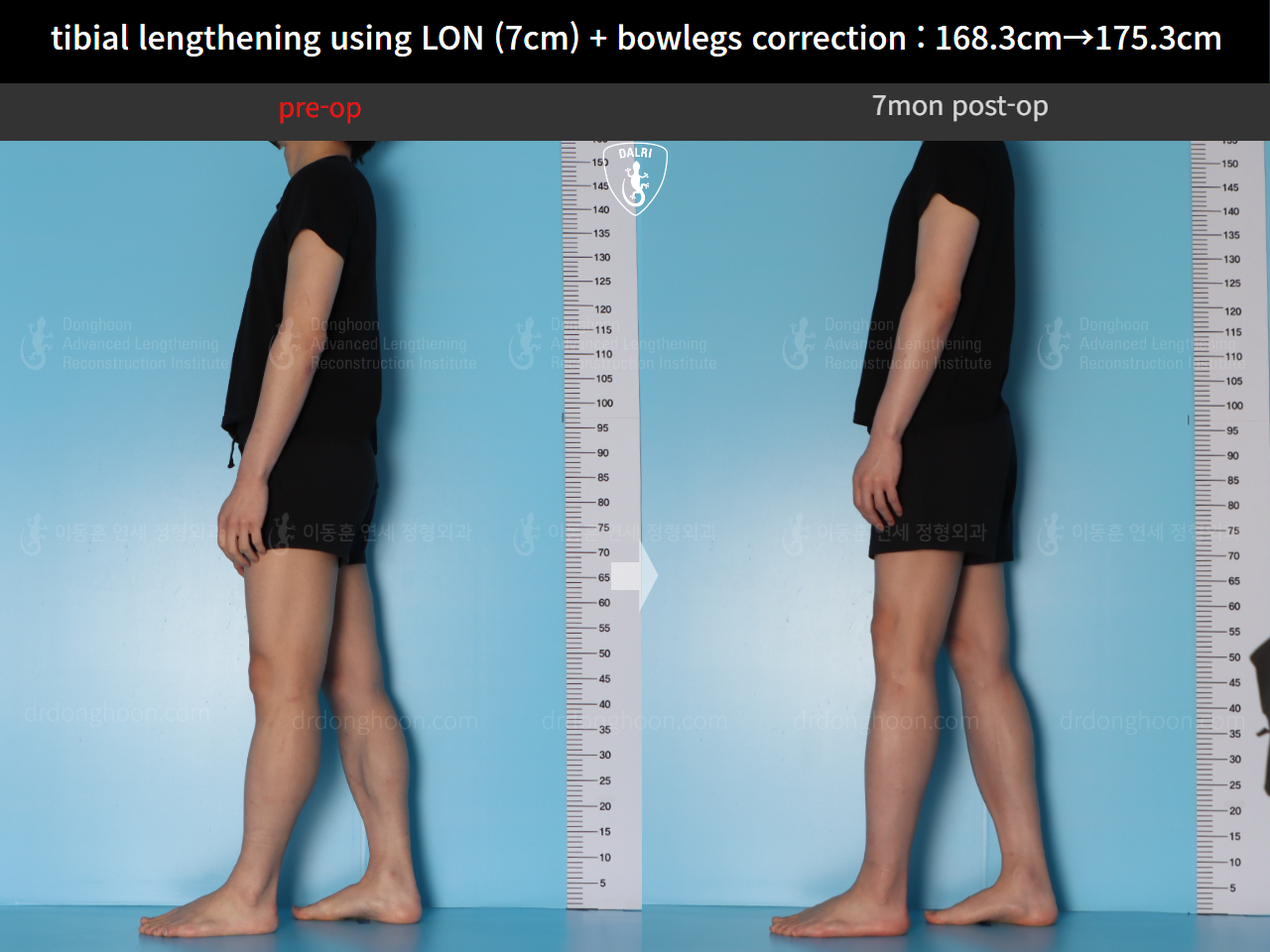 Before and after cll + deformity correction, case 21918246, image 3, Dr. Donghoon institute (DALRI)