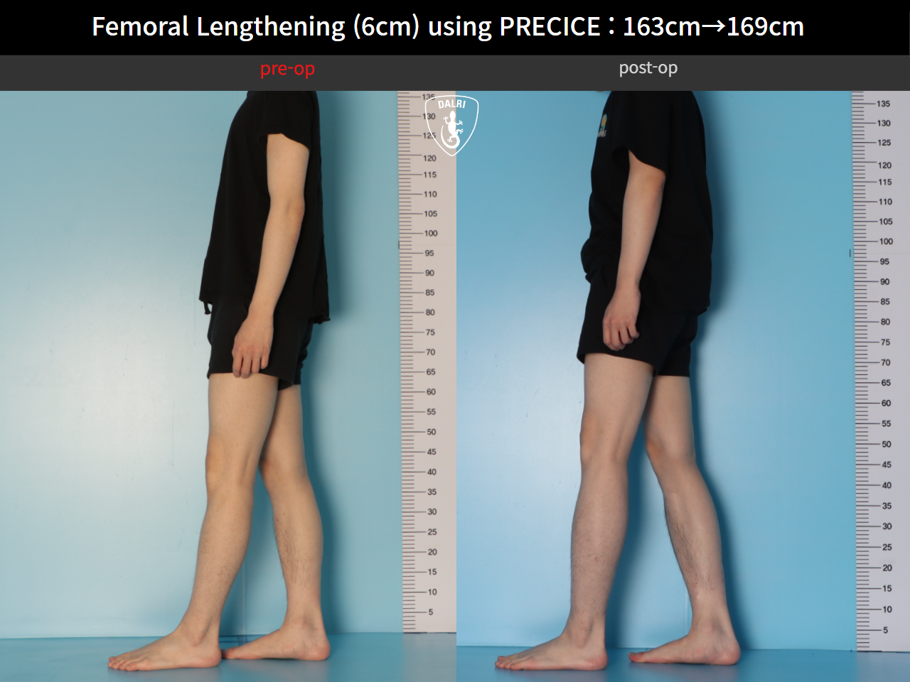 Before and after cll precice, case 33545760, image 4, Dr. Donghoon institute (DALRI)