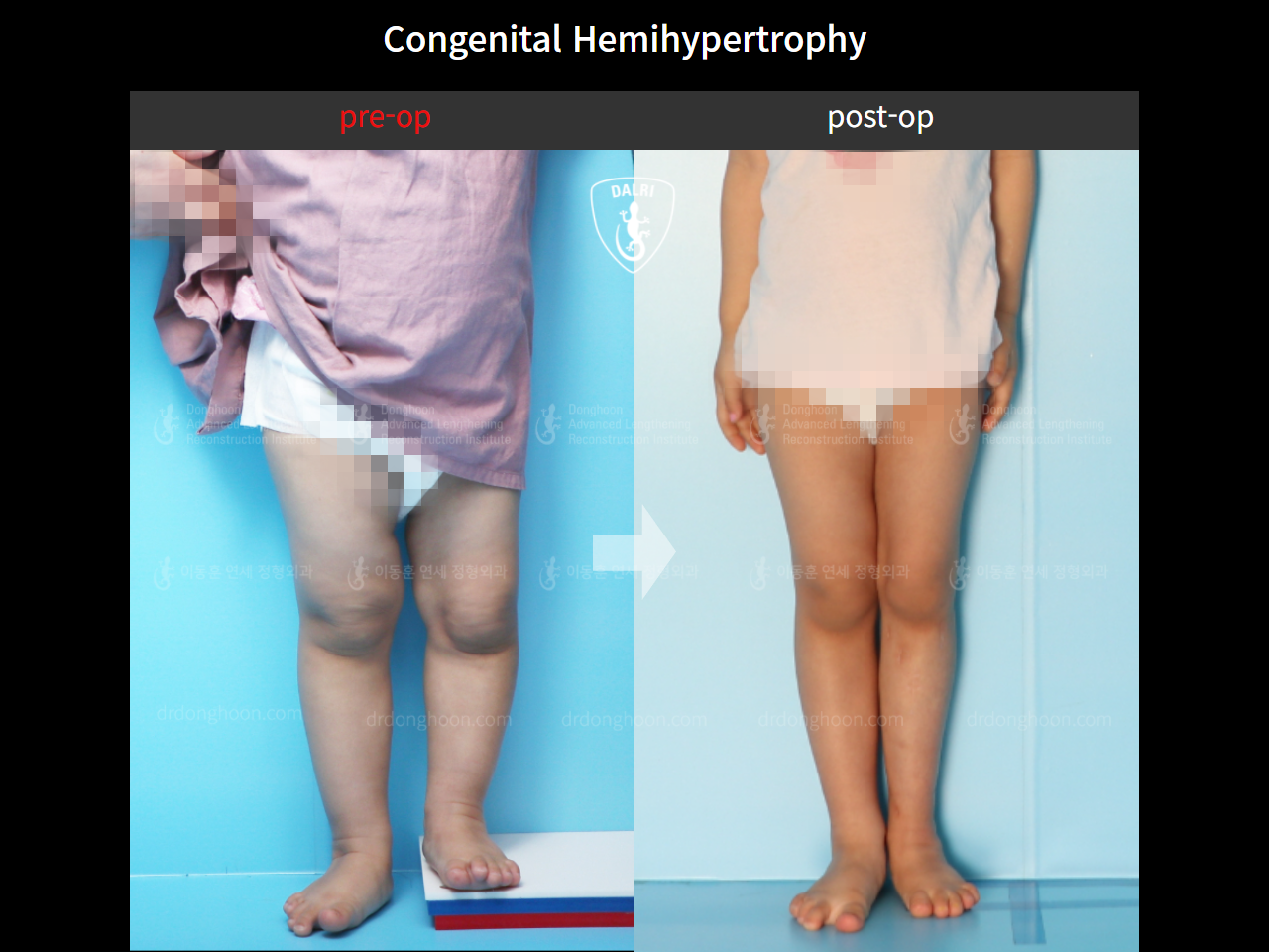 Before and after paediatric congenital condition, case 9478998, image 3, Dr. Donghoon institute (DALRI)