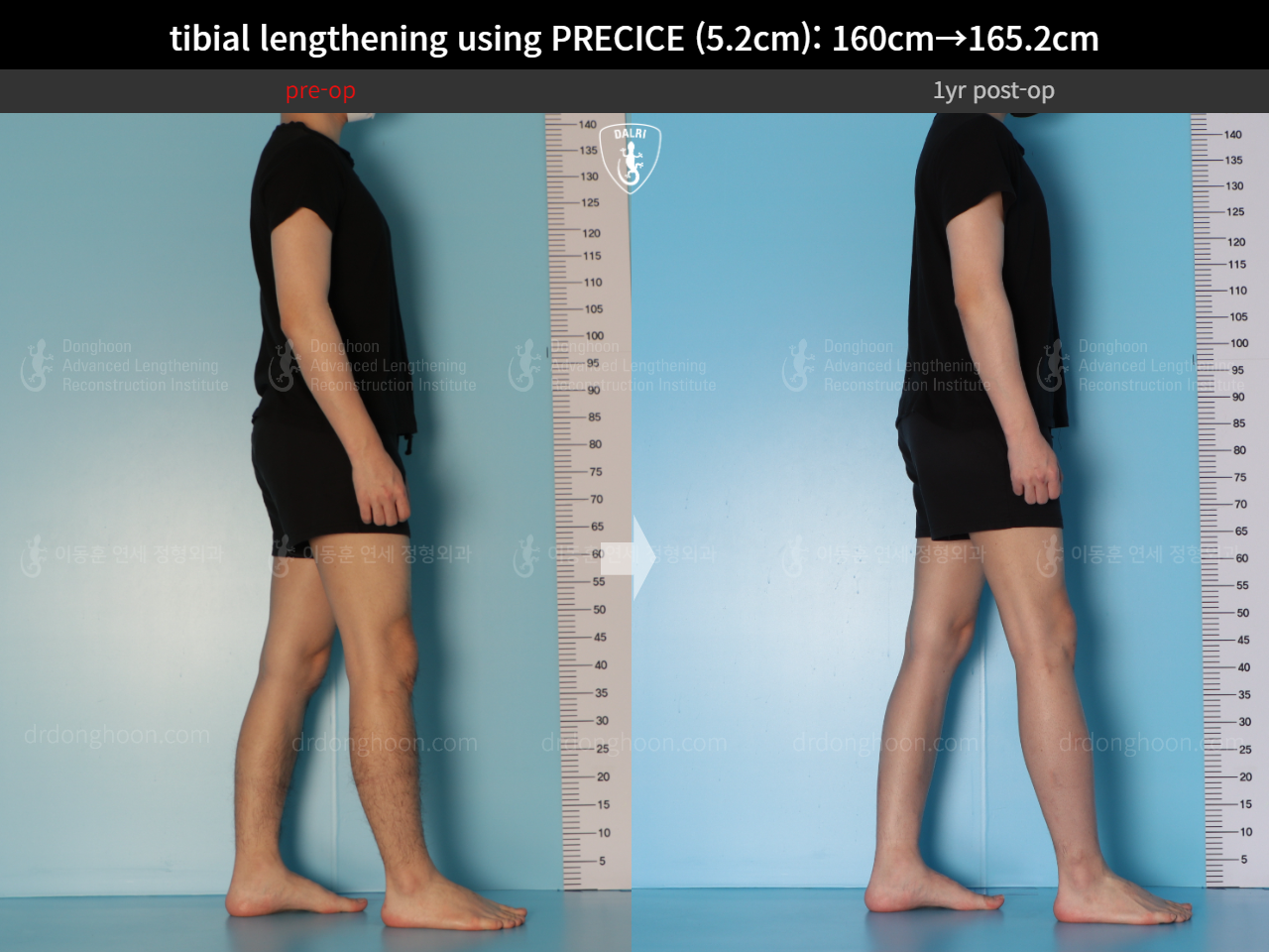 Before and after cll precice, case 15213098, image 5, Dr. Donghoon institute (DALRI)