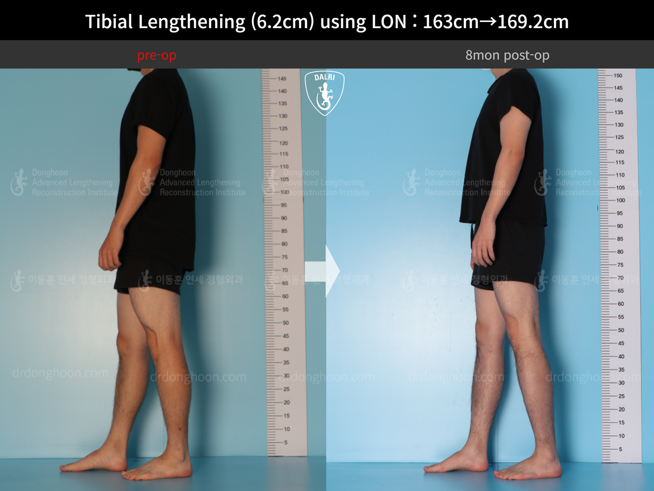 Before and after cll lon, case 14135787, image 6, Dr. Donghoon institute (DALRI)