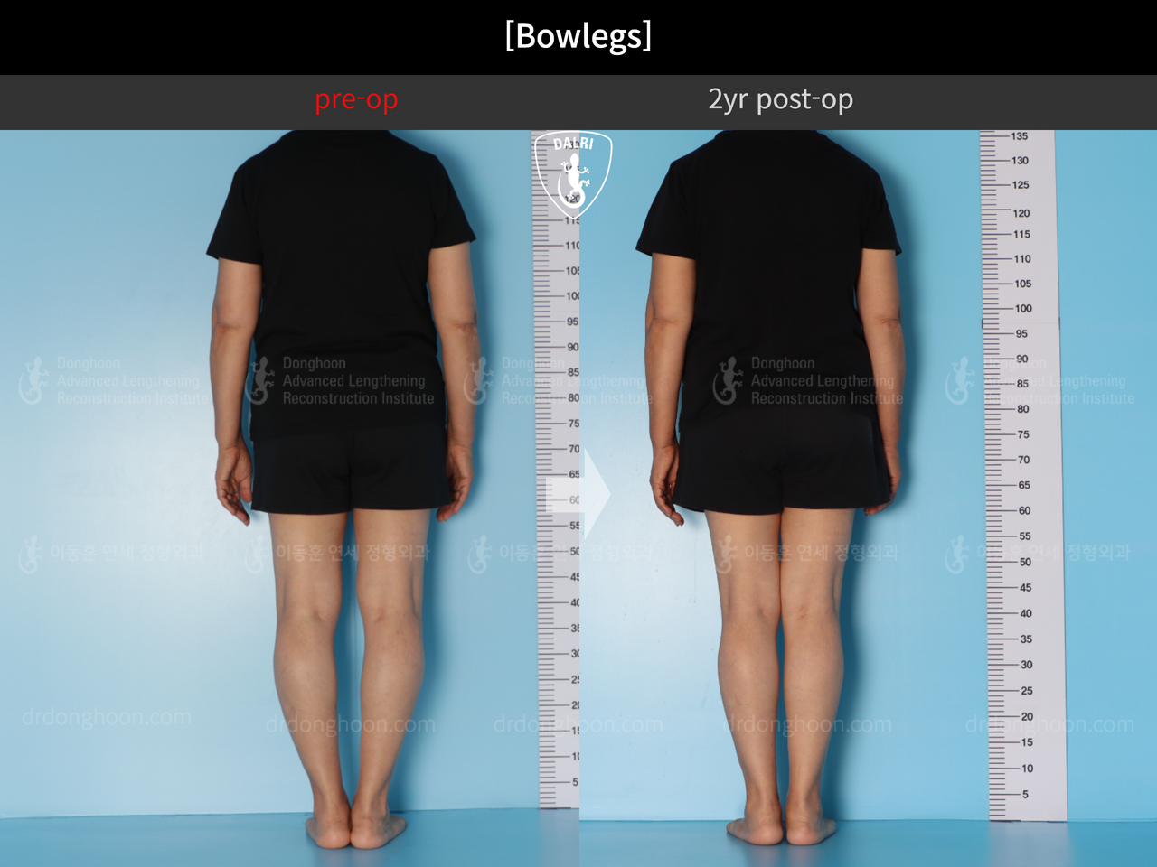 Before and after adult bowlegs, case 13250883, image 4, Dr. Donghoon institute (DALRI)