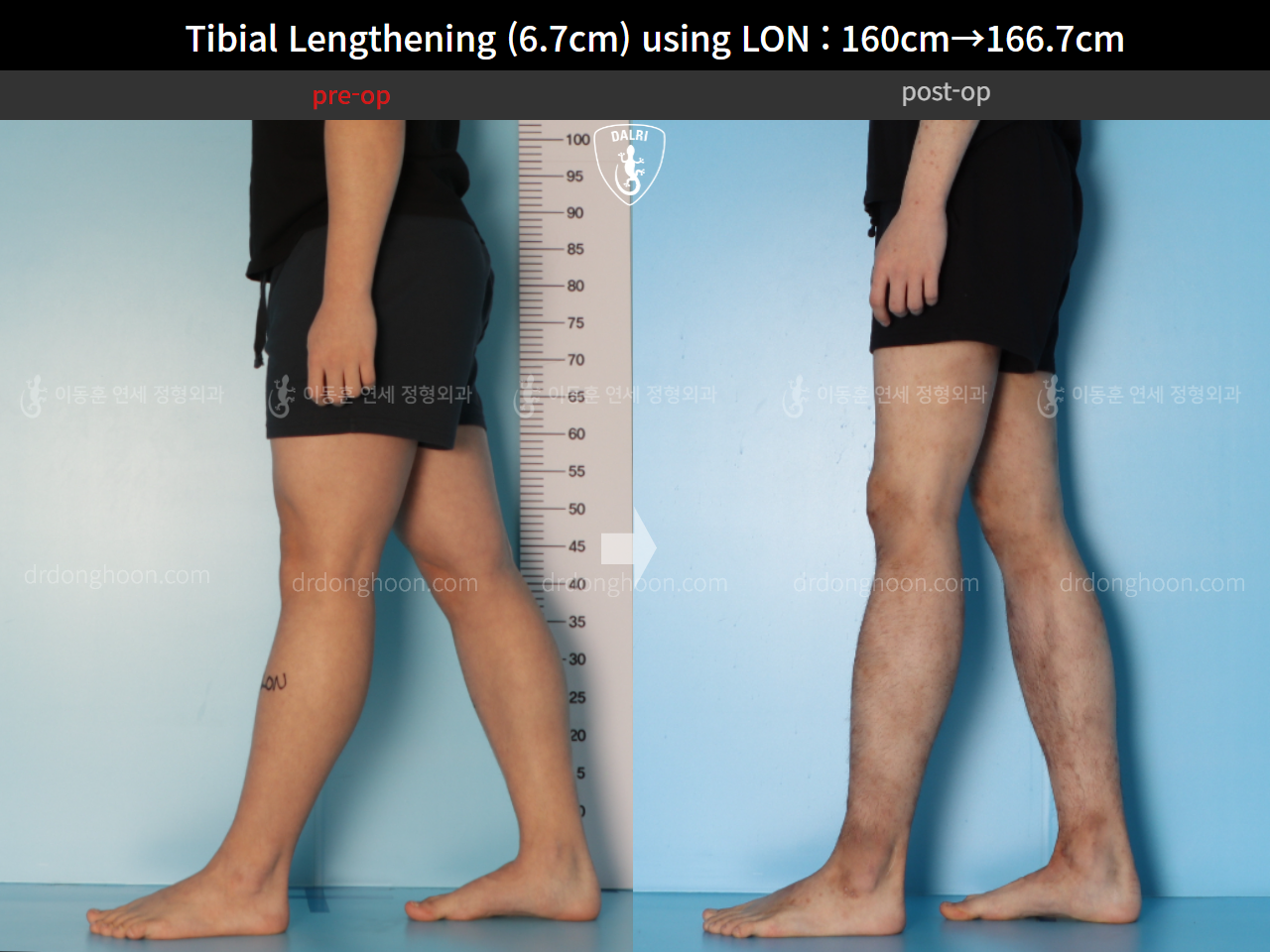 Before and after cll lon, case 15544530, image 7, Dr. Donghoon institute (DALRI)