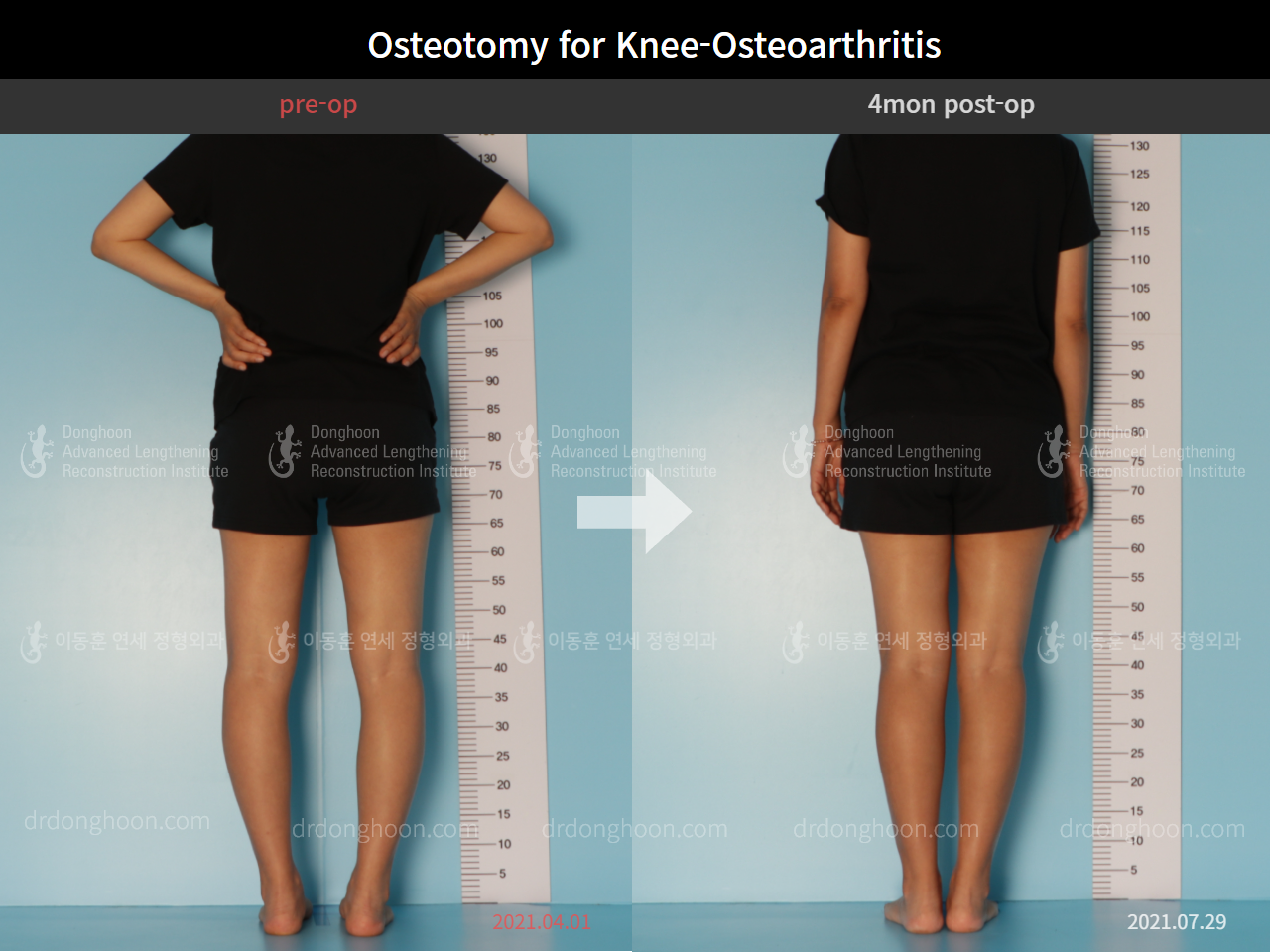 Before and after osteotomy for knee osteoarthritis, case 9075421, image 3, Dr. Donghoon institute (DALRI)