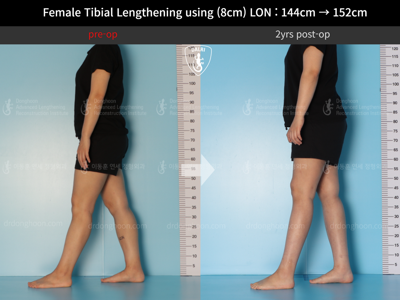 Before and after cll lon, case 12855676, image 5, Dr. Donghoon institute (DALRI)