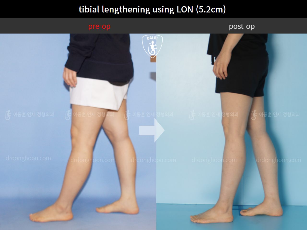 Before and after cll lon, case 4860933, image 8, Dr. Donghoon institute (DALRI)